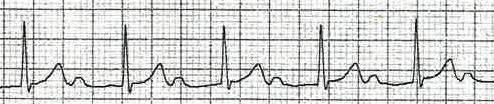 1st degree heart block - prolonged PR interval