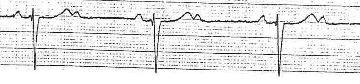3rd degree heart block - P waves with no association to QRS complexes