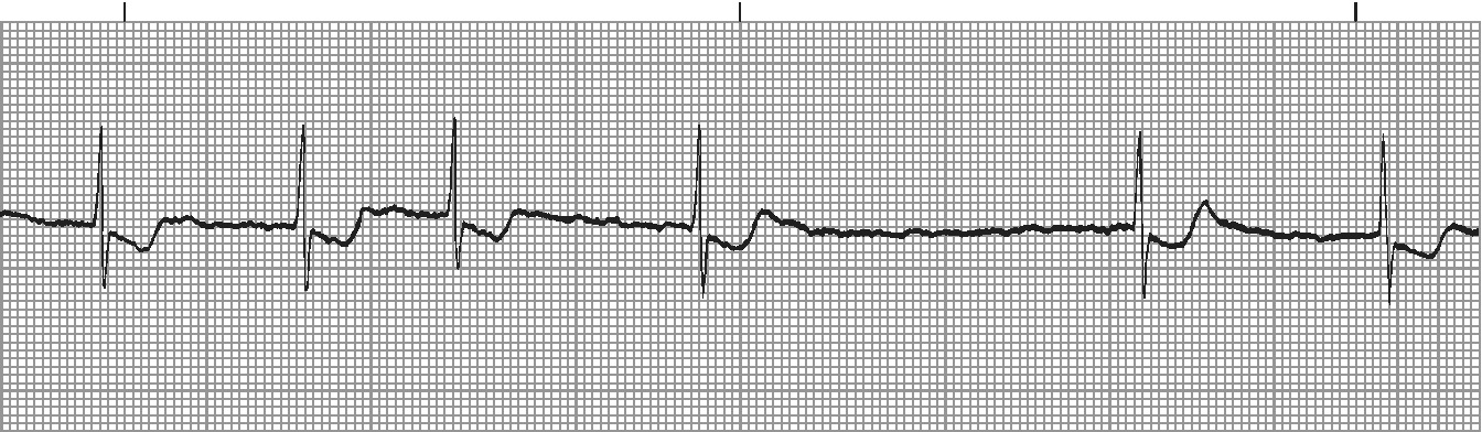 AF with controlled ventricular rate - irregularly irregular but slower