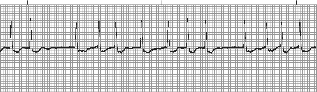 AF with uncontrolled ventricular rate - irregularly irregular with no P waves