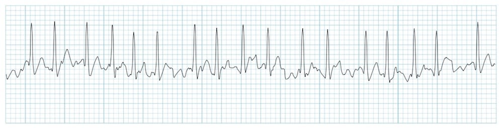 Example ECG showing atrial fibrillation