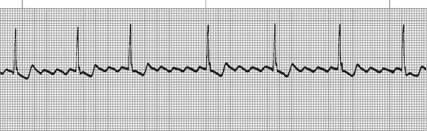 Atrial flutter with sawtooth pattern - flutter waves at ~300/min