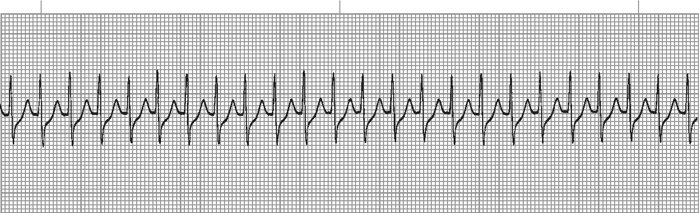 Atrial tachycardia - rapid regular rhythm with abnormal P waves