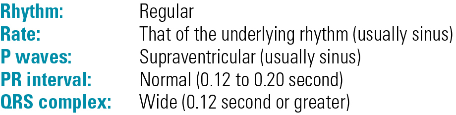 Bundle branch block ECG features - rhythm regular, P waves sinus, QRS wide ≥0.12s