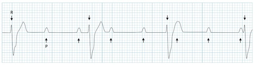 Example ECG showing complete heart block