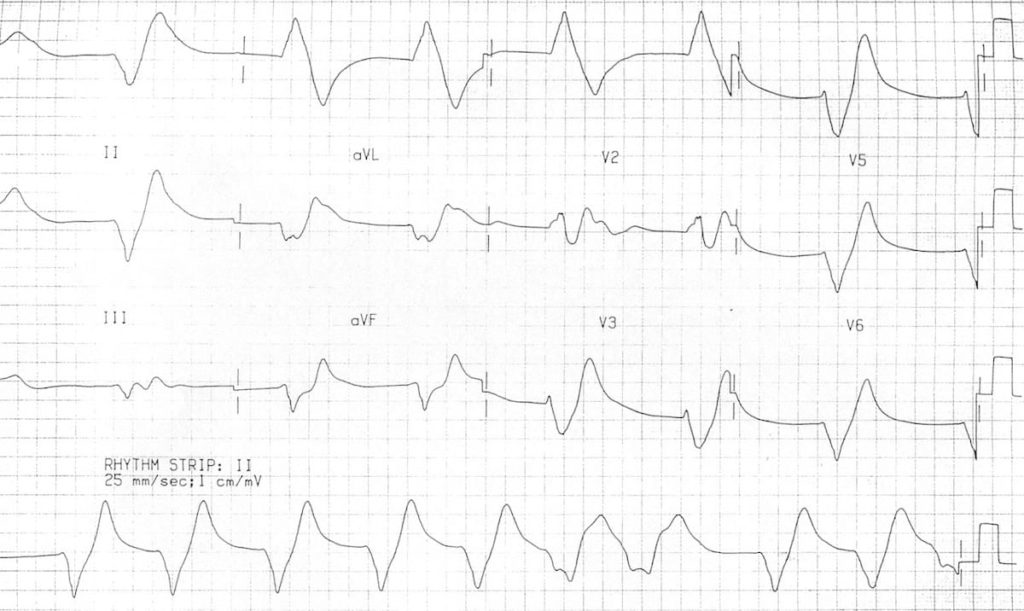 ECG showing severe hyperkalaemia with peaked T waves and widening QRS