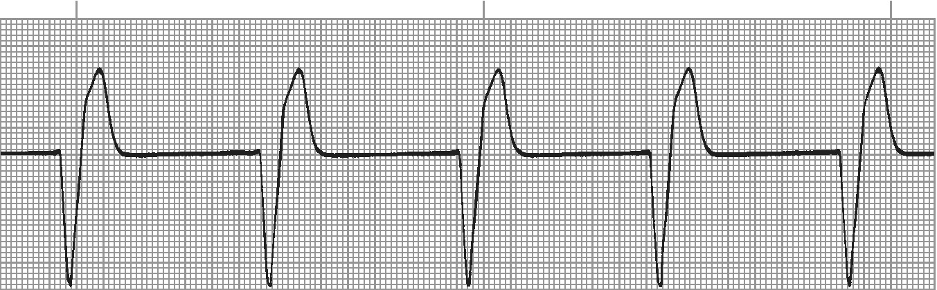 Idioventricular rhythm - slow wide complex rhythm