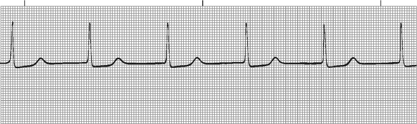 Junctional rhythm - regular narrow complex with no visible P waves