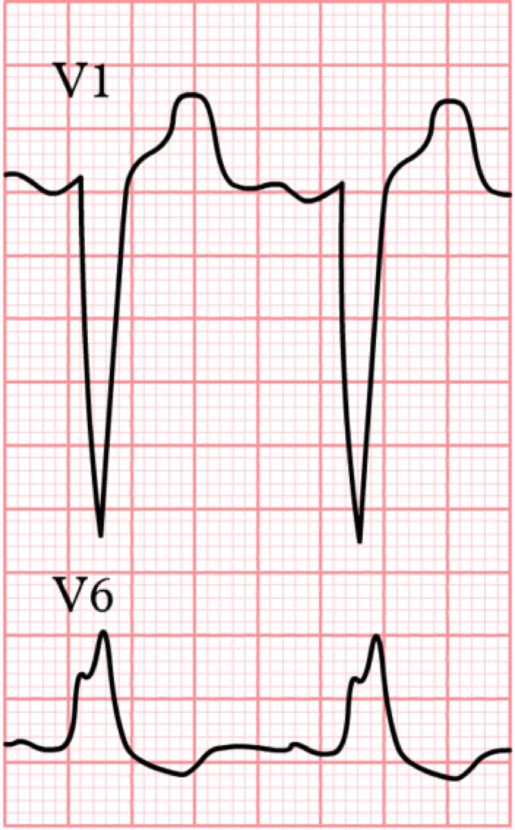 ECG showing left bundle branch block pattern