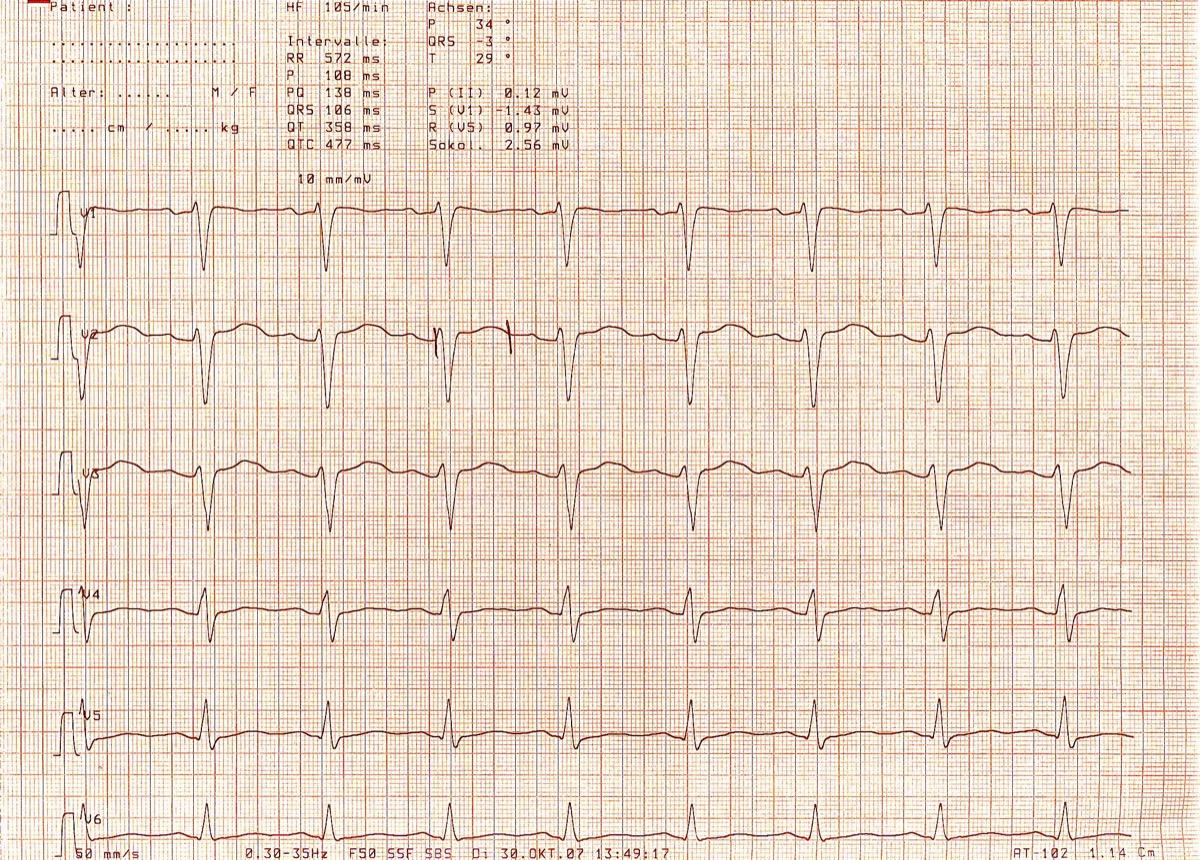 ECG showing prolonged QT interval
