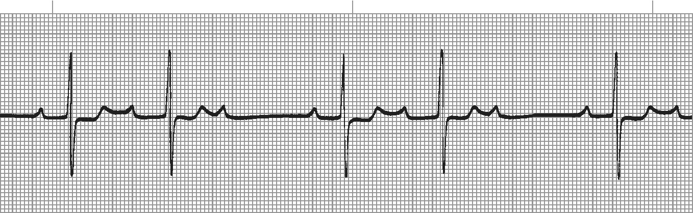 Mobitz I Wenckebach - progressive PR prolongation then dropped beat