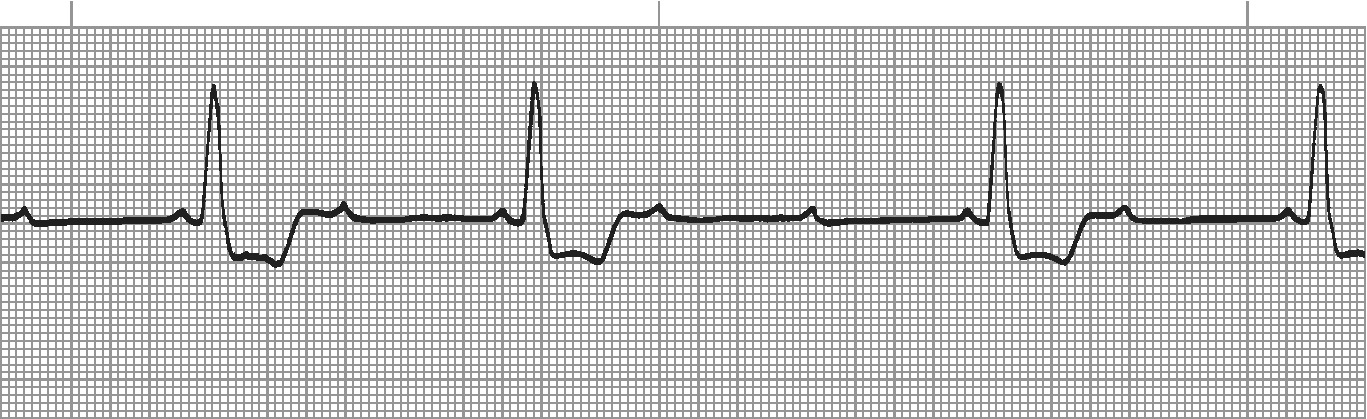 Mobitz II - constant PR interval with intermittent dropped QRS