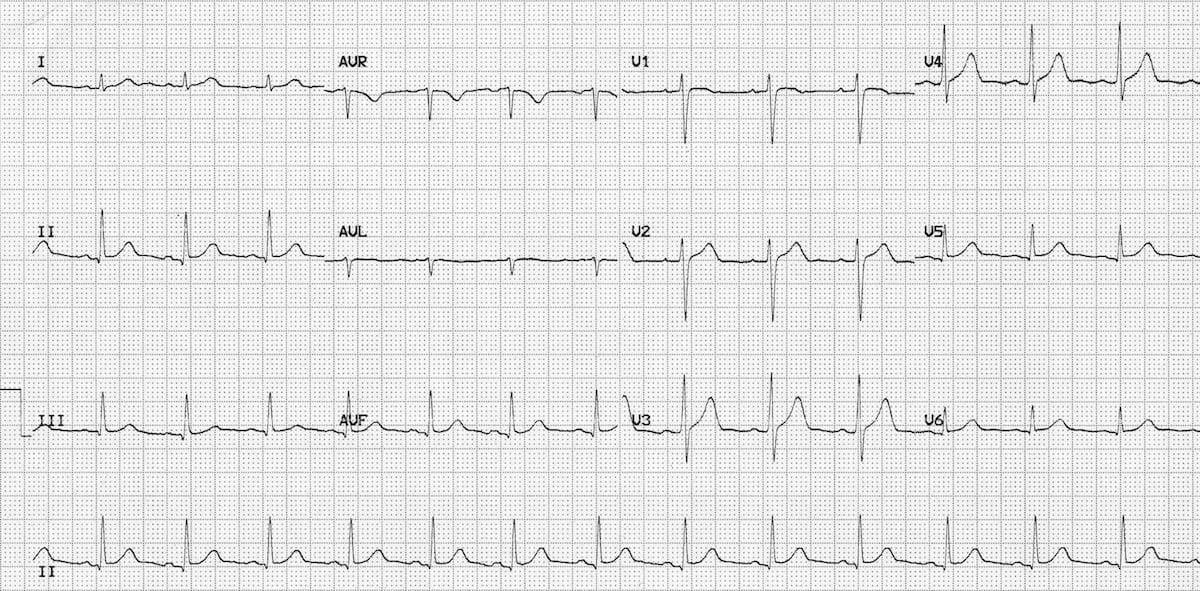 Example 12-lead ECG showing normal sinus rhythm