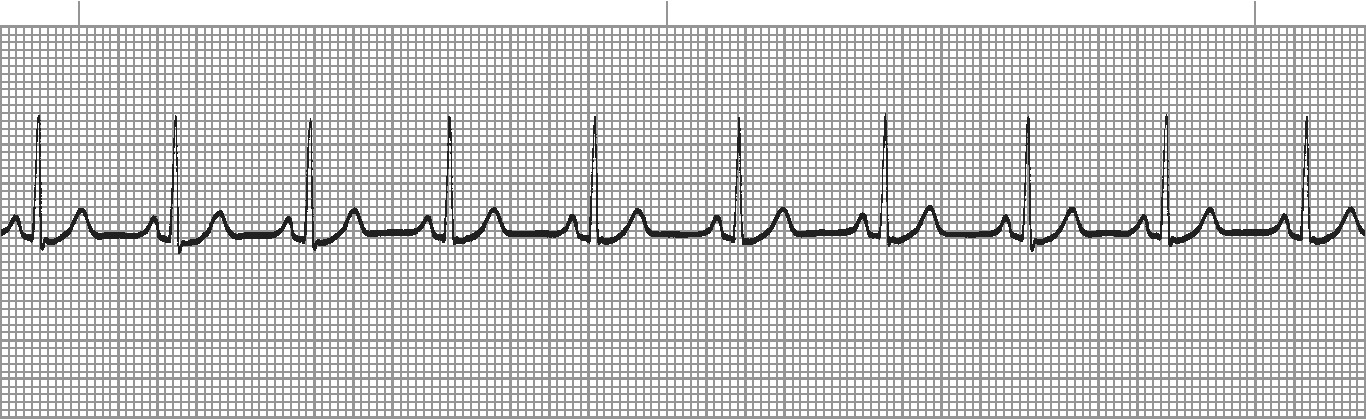 Normal sinus rhythm - regular rhythm, rate 60-100, upright P waves