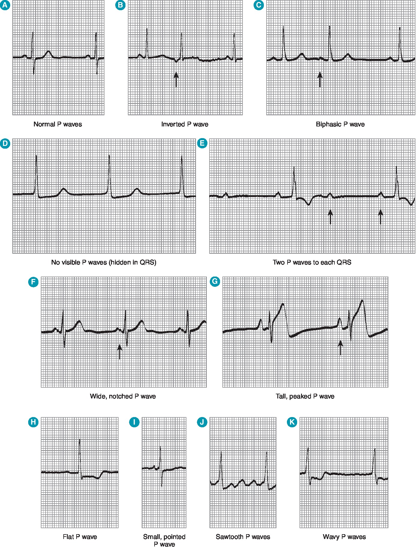 P wave variations: normal, inverted, biphasic, hidden, wide notched (LAE), tall peaked (RAE), sawtooth (flutter), wavy (AF)