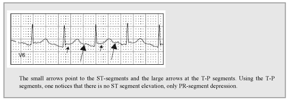 Pericarditis - PR segment depression with explanation