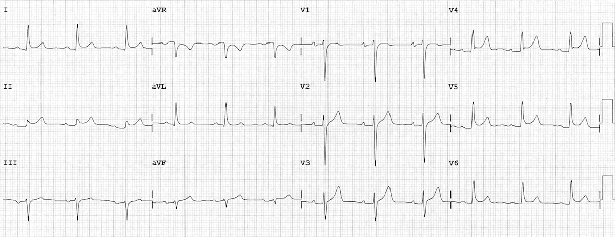 Example ECG showing pericarditis