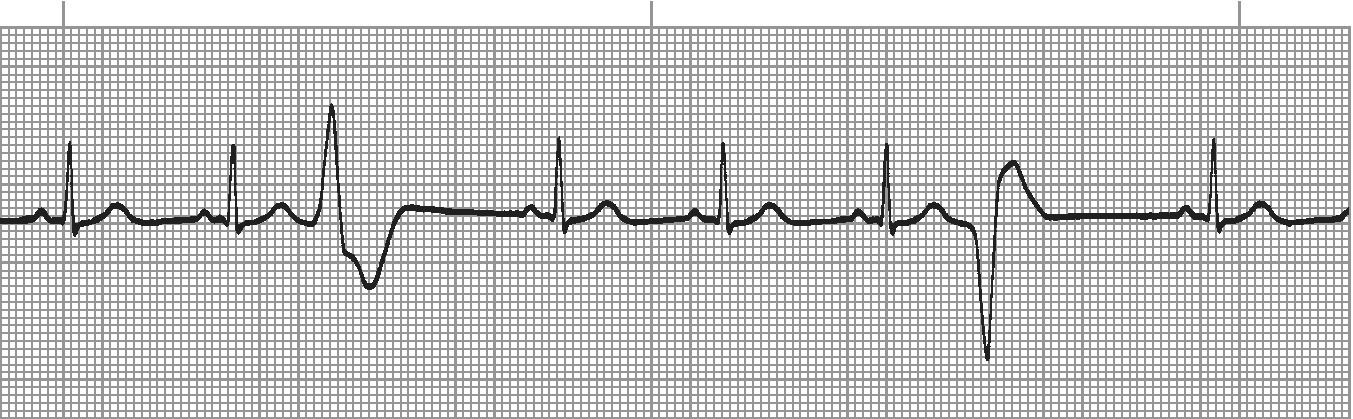 Multifocal PVCs - varying morphology from multiple foci
