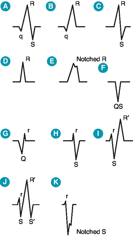 QRS complex variations including RSR' pattern seen in BBB