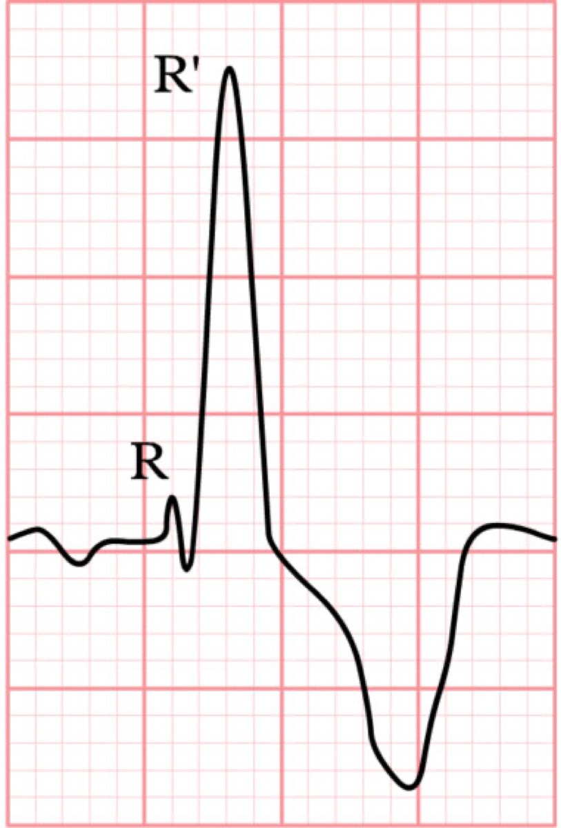 ECG showing right bundle branch block pattern