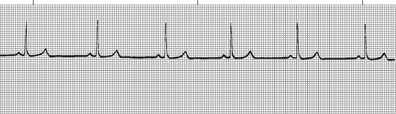 Sinus arrhythmia - P waves present but R-R intervals vary with respiration