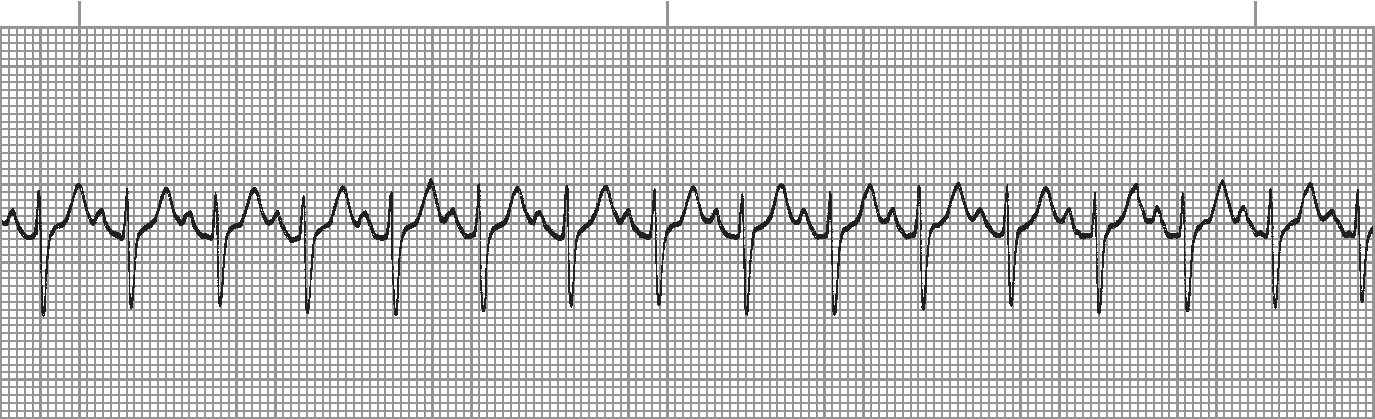 Sinus tachycardia - regular sinus rhythm with rate over 100
