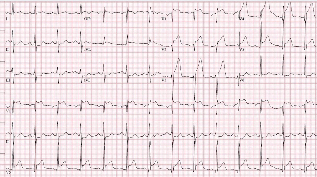Example ECG showing anterior ST-elevation myocardial infarction