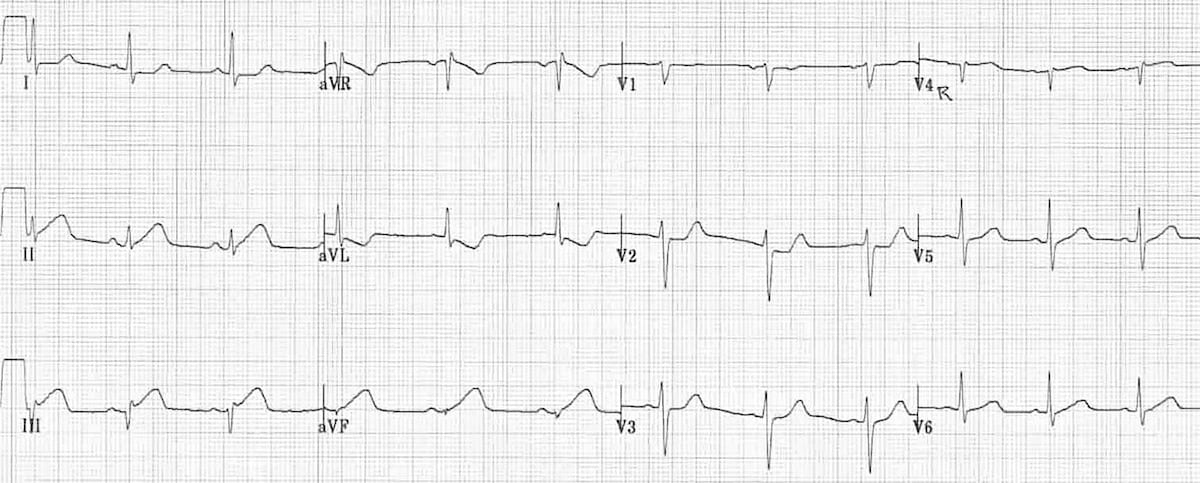 Example ECG showing inferior ST-elevation myocardial infarction
