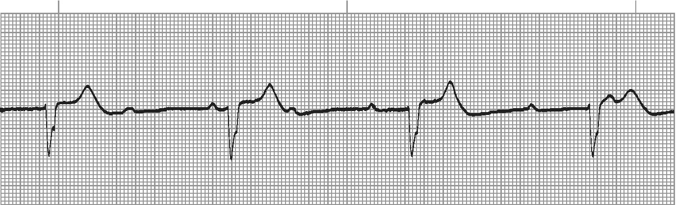 Third degree heart block - P waves with no relationship to QRS complexes