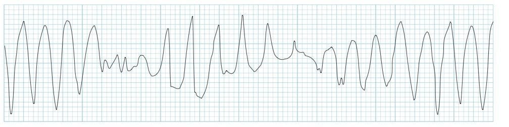 Example ECG showing torsades de pointes