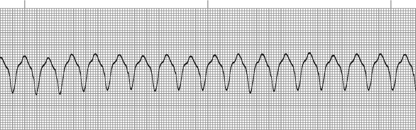 Monomorphic VT - regular wide complex tachycardia