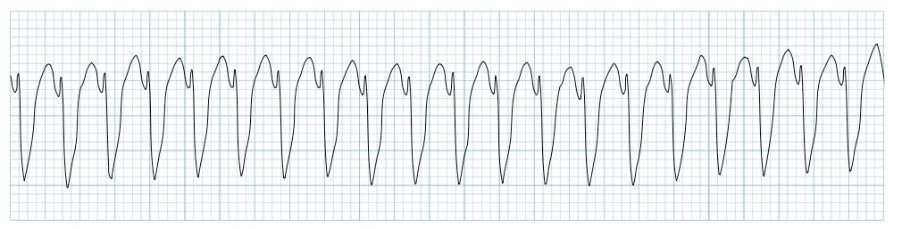 Example ECG showing monomorphic ventricular tachycardia