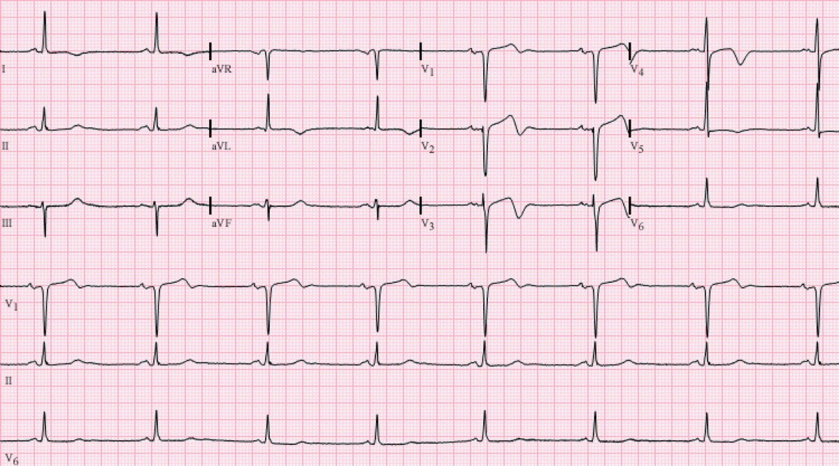 ECG showing Wellens pattern with deep T wave inversion in V2-V3