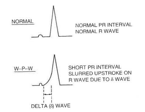 WPW syndrome showing short PR interval and delta wave compared to normal